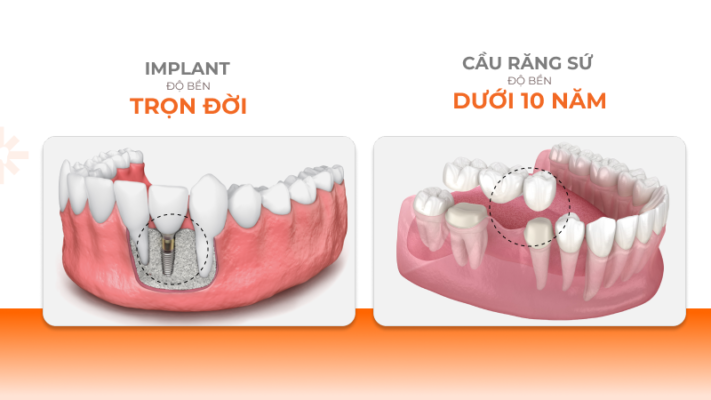 Tuổi thọ răng implant cao hơn các phương pháp khác