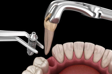 Cấy implant tức thì ngay sau nhổ răng