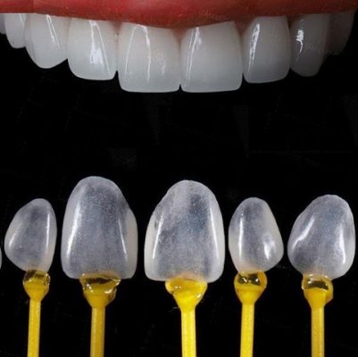 bọc sứ không mài