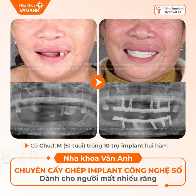 trồng răng implant nha khoa vân anh