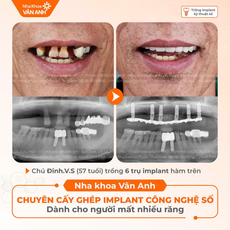trồng răng implant nha khoa vân anh