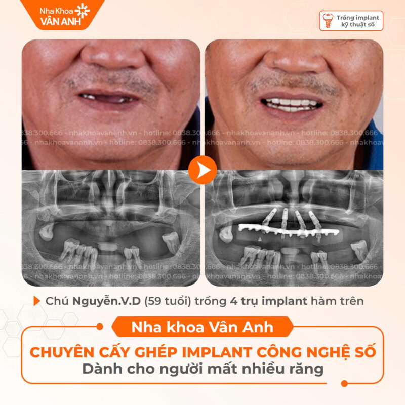 trồng răng implant nha khoa vân anh