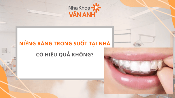 Niềng Răng Trong Suốt Tại Nhà