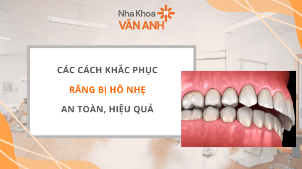 răng bị hô nhẹ