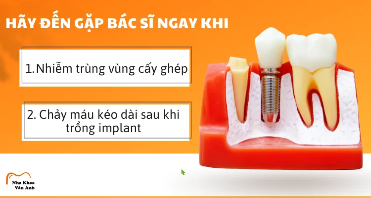 trồng răng implant mất bao nhiêu thời gian