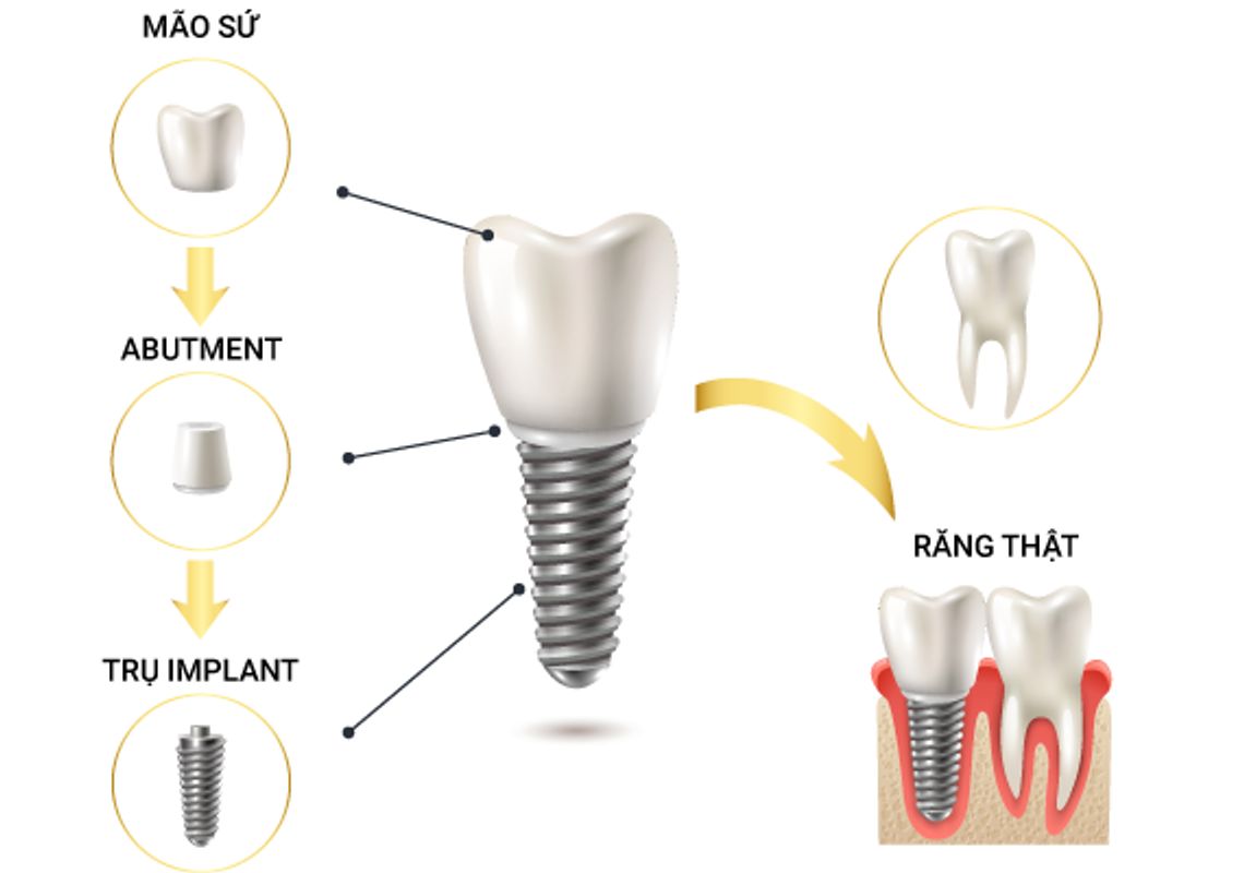 Trồng răng Implant all on 4 là gì? 