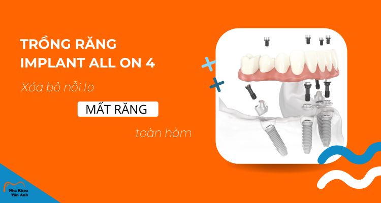 Trồng Răng Implant All On 4