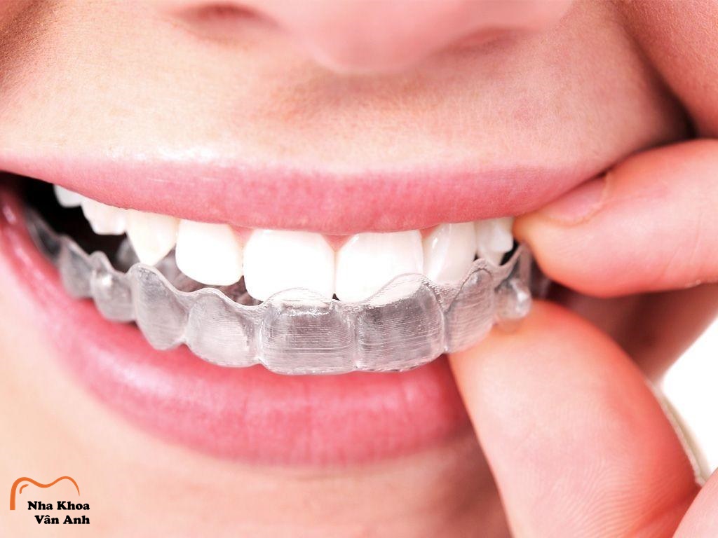 5 Điều Bạn Cần Biết Về Niềng Răng Bằng Máng Trong Suốt