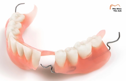 Hàm giả tháo lắp – phương pháp trồng răng giả phổ biến