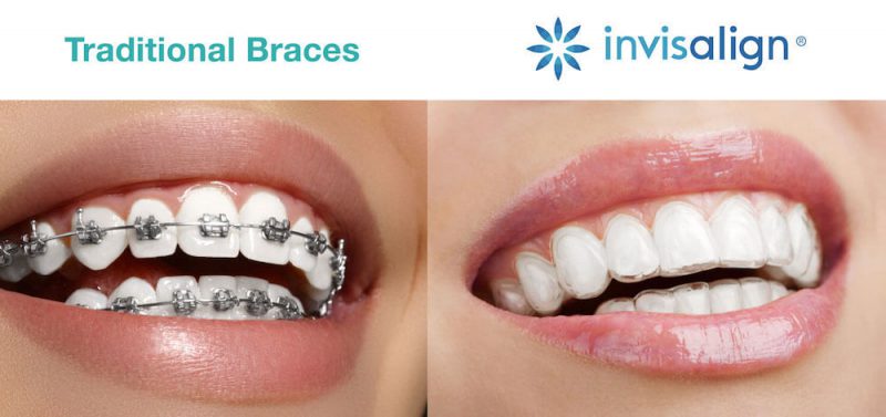 So sánh niềng răng mắc cài và niềng răng trong suốt. Nên lựa chọn loại nào?