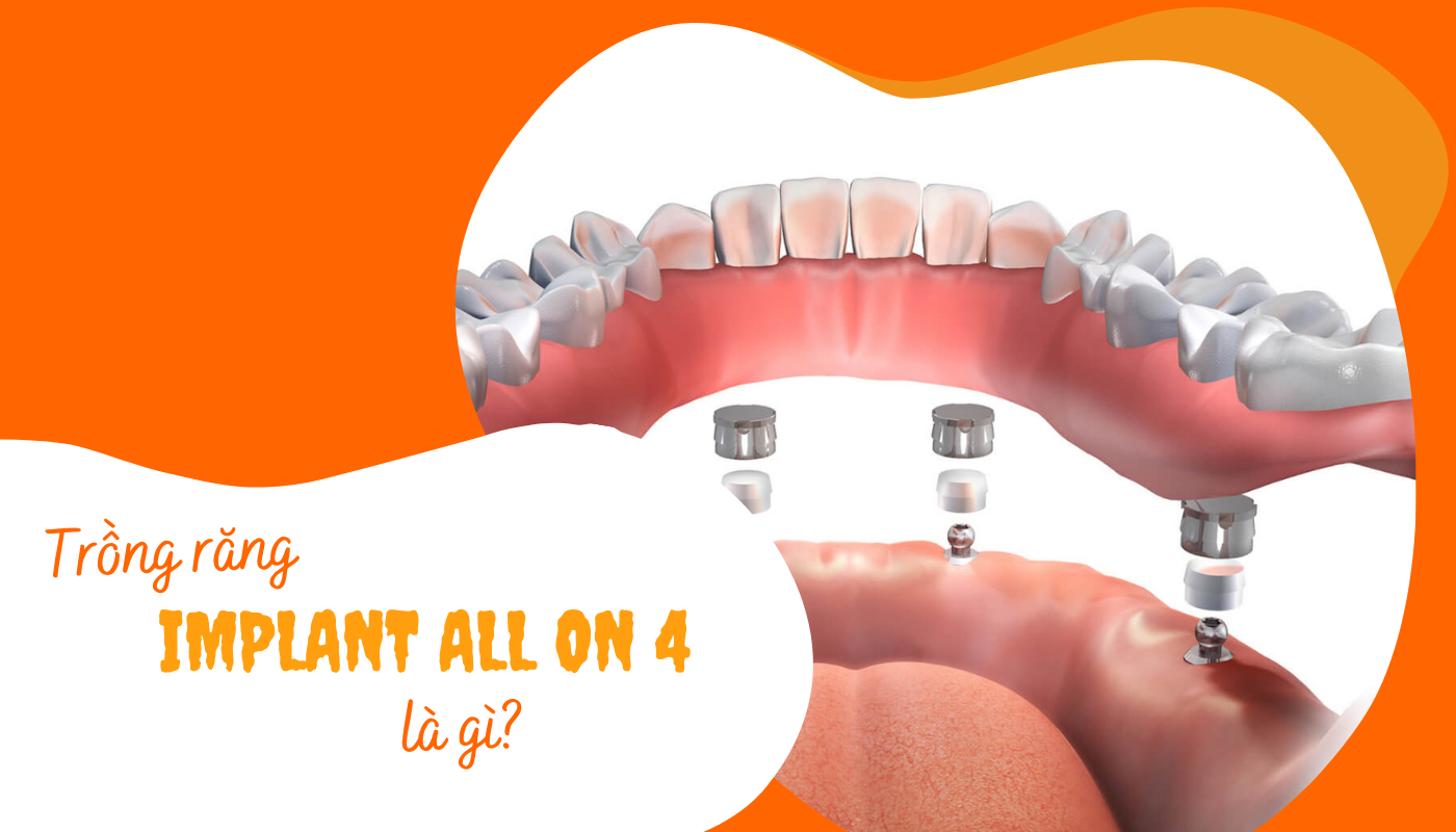 Trồng răng Implant All On 4 là gì? 