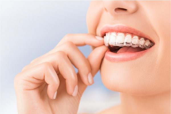  Phương pháp mới nhất: niềng răng trong suốt Invisalign 