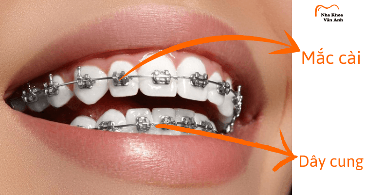 niềng răng mắc cài