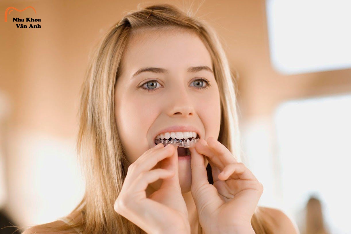 Quy trình niềng răng trong suốt