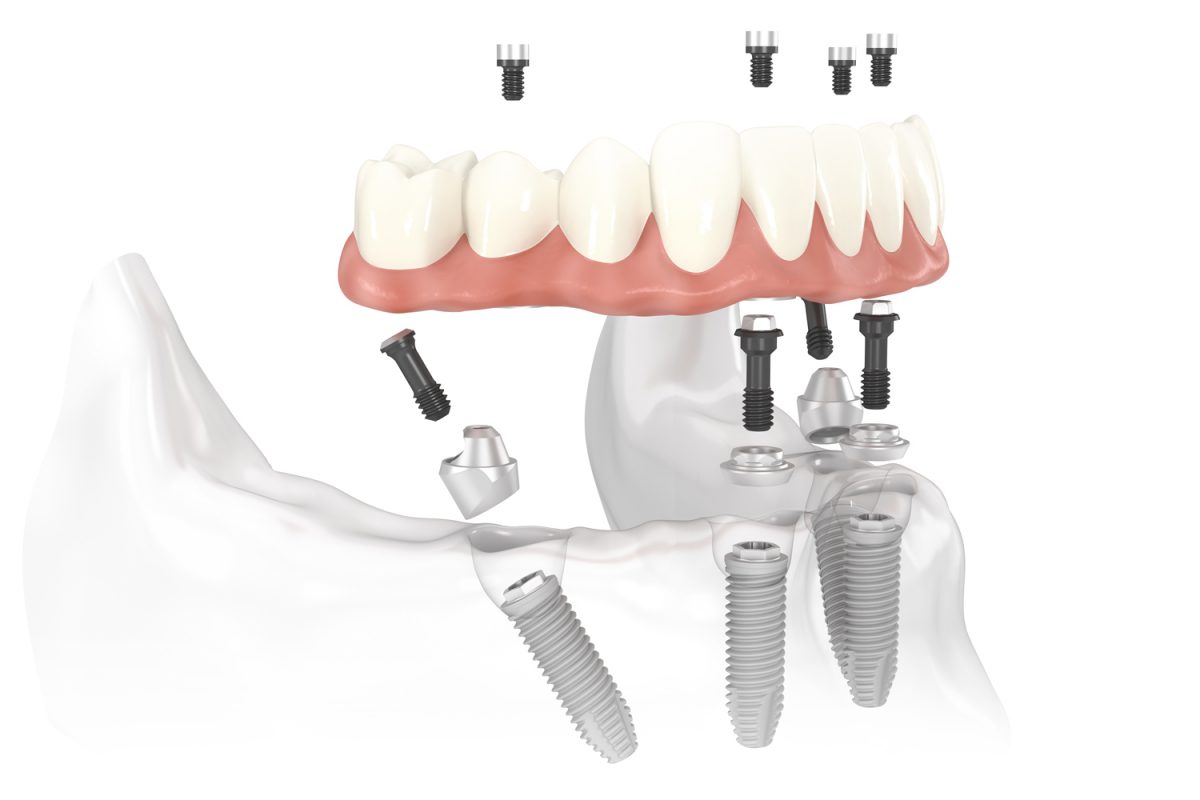 Ưu điểm của trồng răng Implant all on 4
