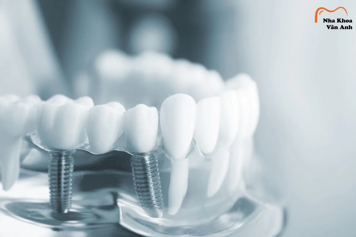 trong rang implant mat bao nhieu thoi gian