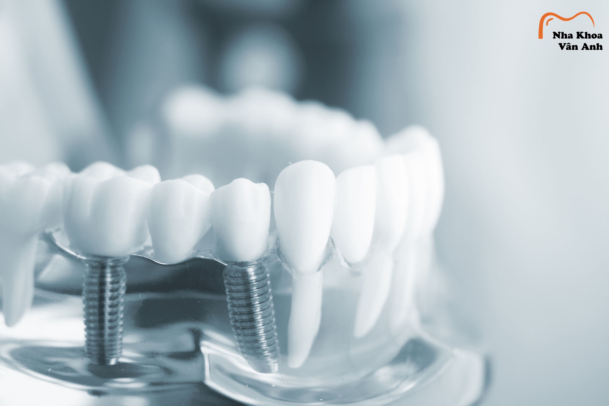 Những yếu tố quyết định trồng răng Implant có đau không?