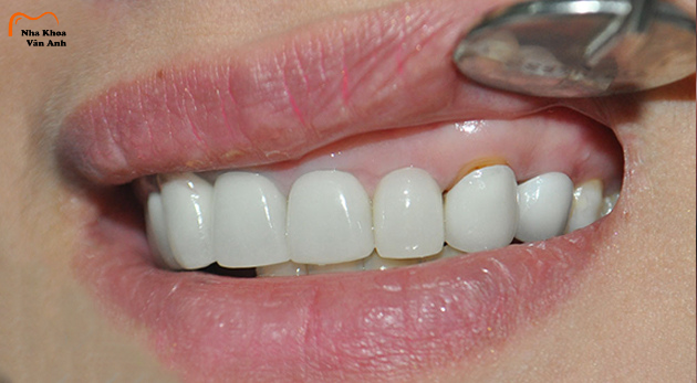 Dấu hiệu răng sứ bị hở là gì? Cách khắc phục thế nào