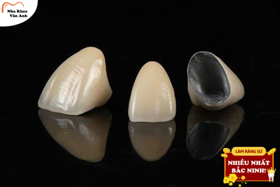 Trường hợp nào nên sử dụng răng sứ kim loại?