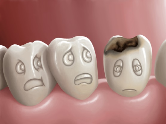 Có nên bọc răng sứ cho răng sâu không? Giá bao nhiêu?
