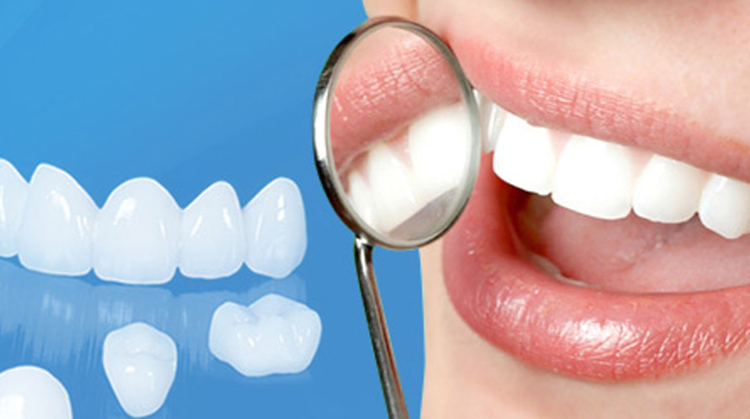 Bọc răng sứ giá bao nhiêu? Có những loại nào?