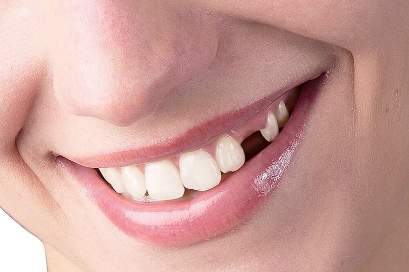 Mất răng lâu năm có trồng được không? Trồng răng bằng cách nào?