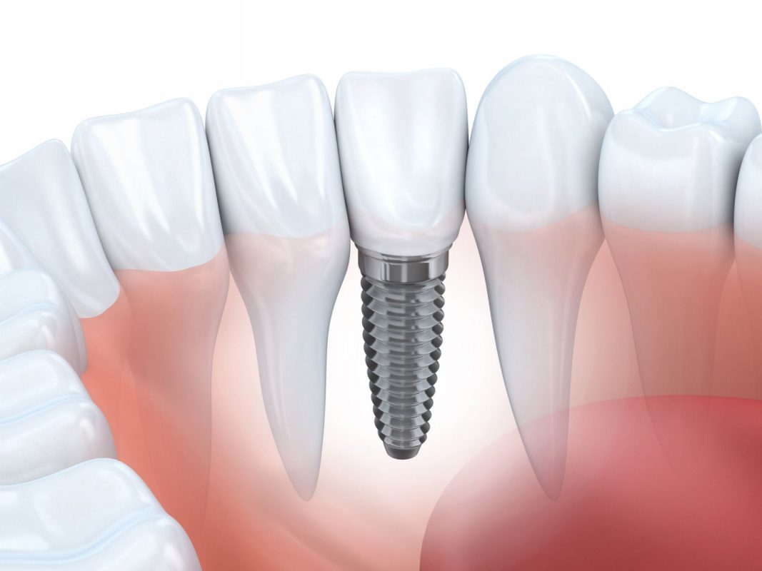 Bảng giá trồng răng implant trọn gói 2022
