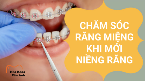 chăm sóc răng miệng khi mới niềng răng
