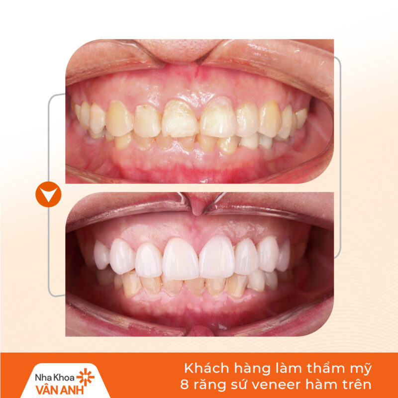 dán sứ veneer nha khoa vân anh