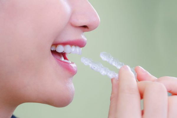 Niềng răng trong suốt Invisalign là gì?  