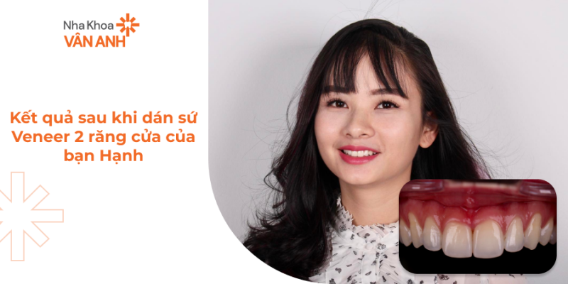 ket-qua-sau-khi-dan-su-veneer