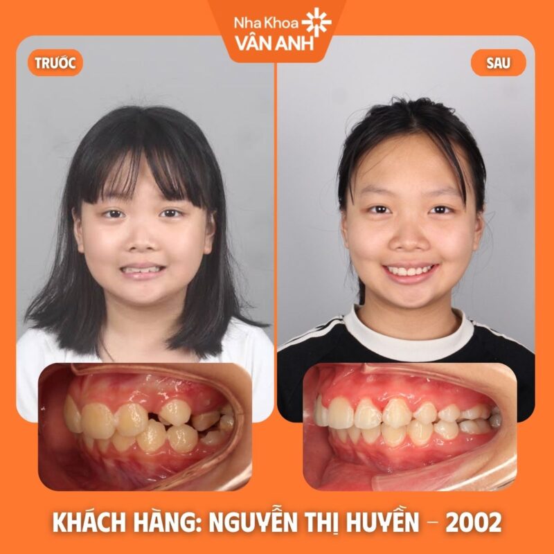 niềng răng nha khoa vân anh