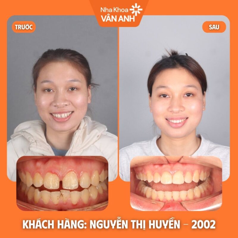 niềng răng nha khoa vân anh