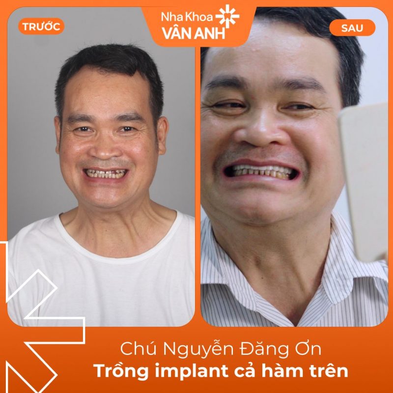 KH TRỒNG IMPLANT