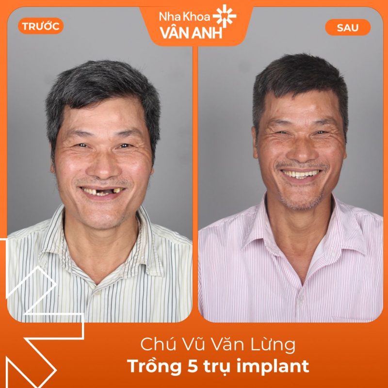khach-hang-trong-implant