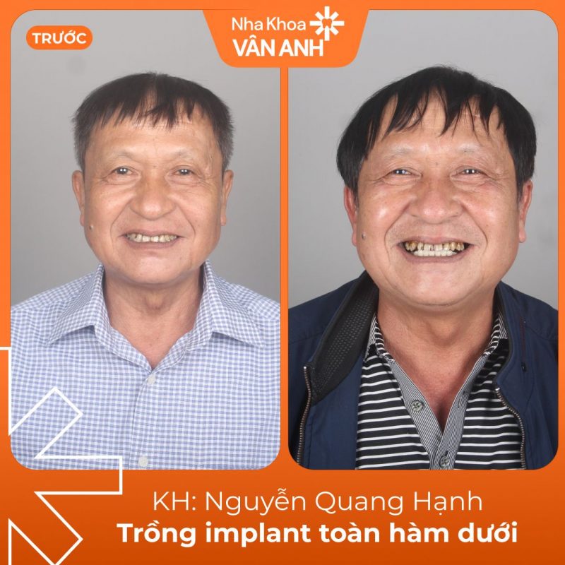 khach-hang-trong-implant