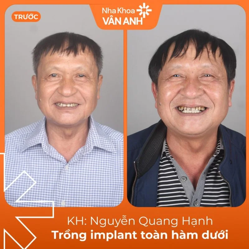 khach-hang-trong-implant