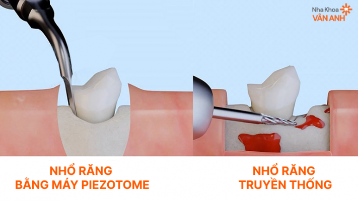 so-sanh-nho-rang-piezotome-va-truyen-thong