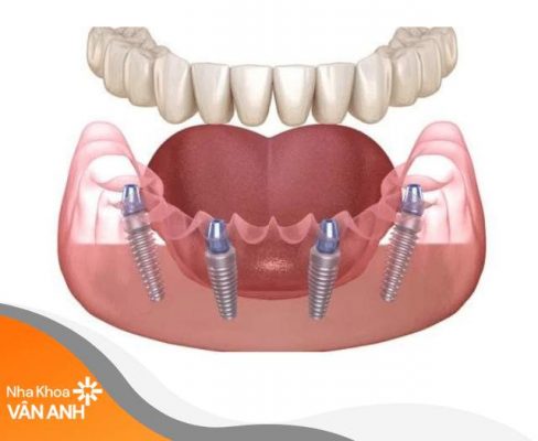 trồng răng implant