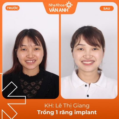 khach-hang-trong-implant