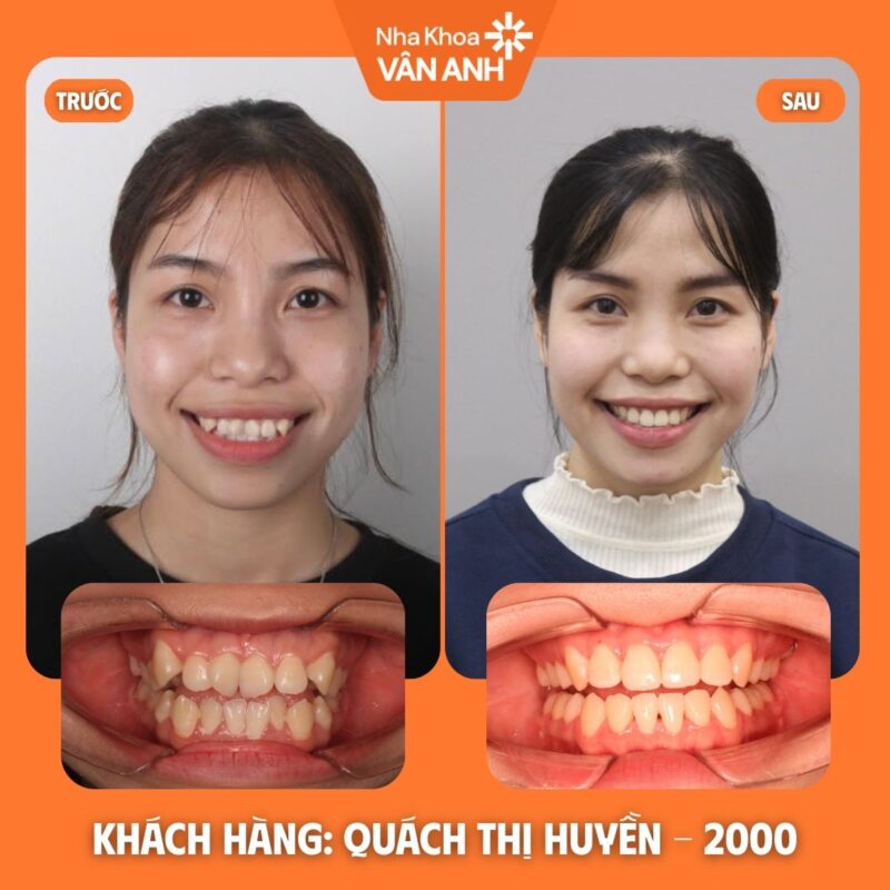 NIỀNG RĂNG NHA KHOA VÂN ANH (1)