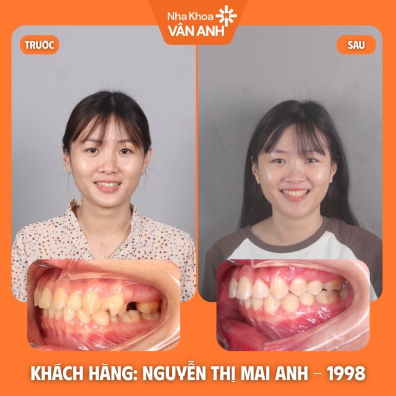 niềng răng nha khoa vân anh