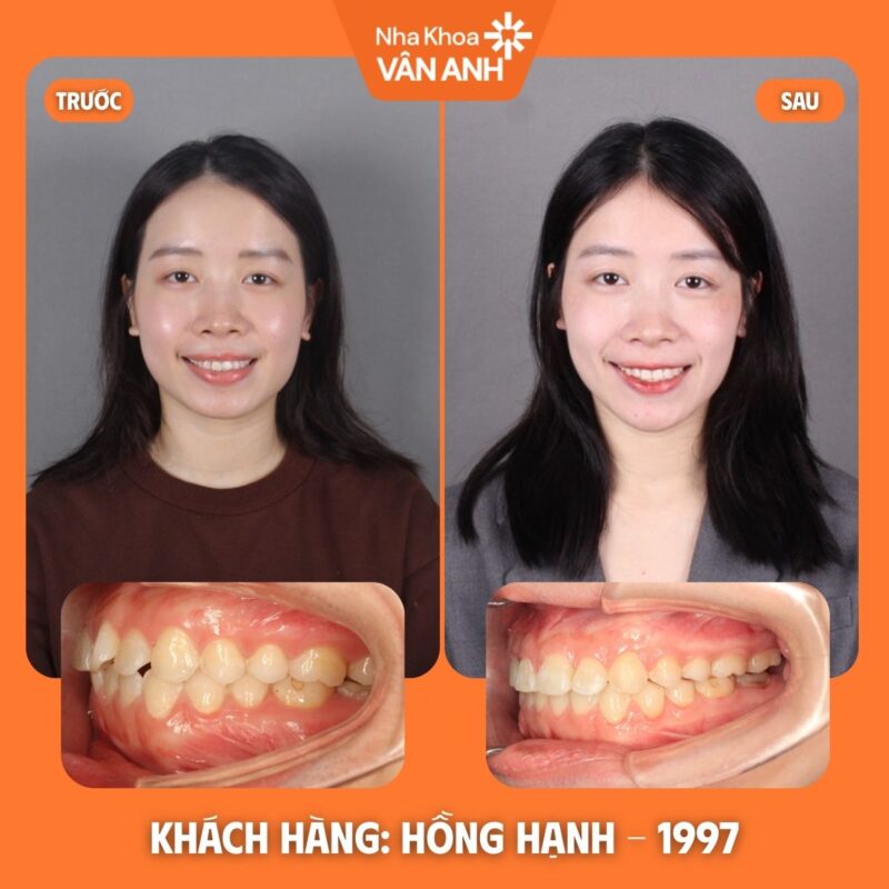 niềng răng nha khoa vân anh