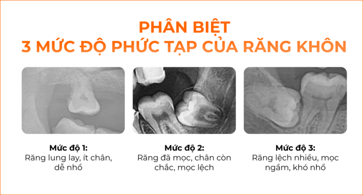 3 mức độ khó nhổ răng khôn