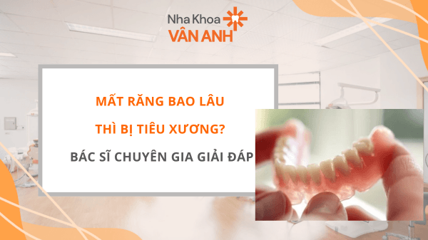 MẤT RĂNG BAO LÂU THÌ BỊ TIÊU XƯƠNG
