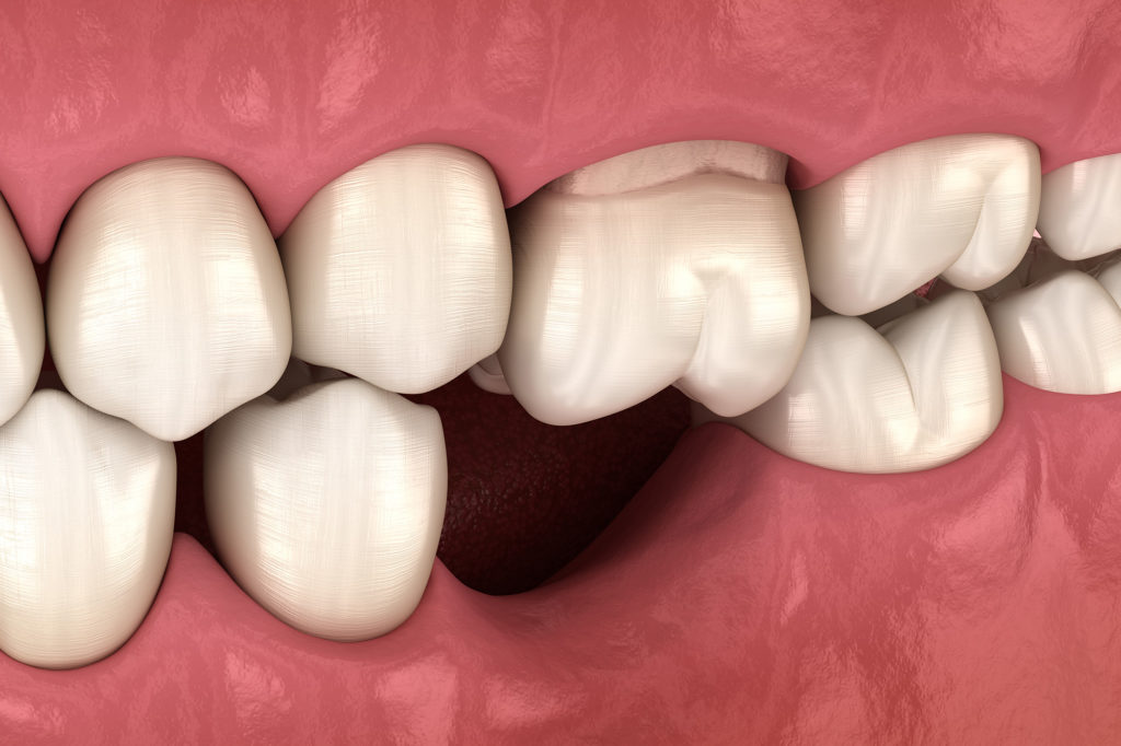 Mất răng bao lâu thì bị tiêu xương là câu hỏi nhiều bệnh nhân thắc mắc 
