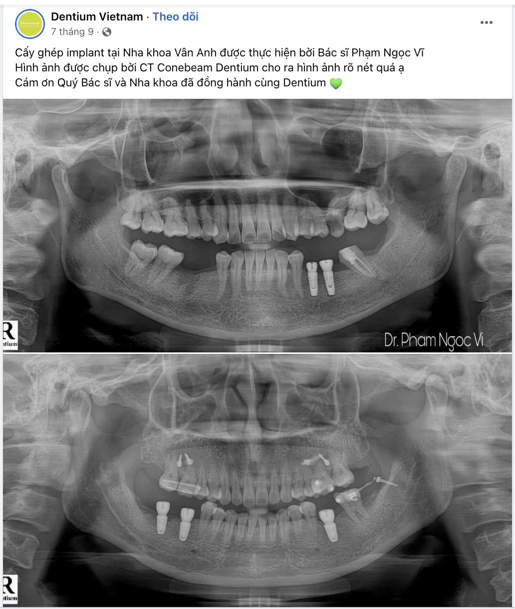 Trồng răng implant