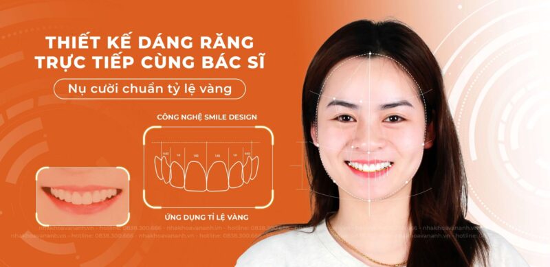 công nghệ smiledesign