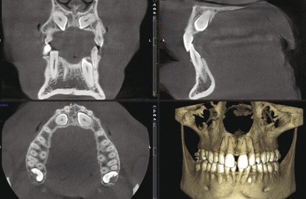 chụp ct conebeam trồng răng implant