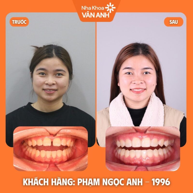 niềng răng nha khoa vân anh (4)